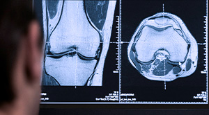 Lesão do ligamento cruzado anterior (LCA)